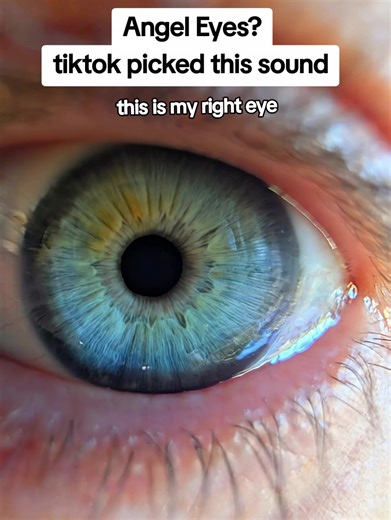 Angel Eyes: Discover the Beauty of Heterochromia