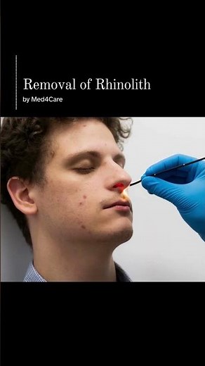Removal of Rhinolith