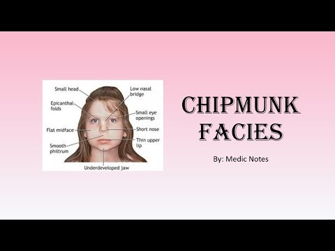 Chipmunk facies - beta thalassemia, parotid gland enlargement, mechanism