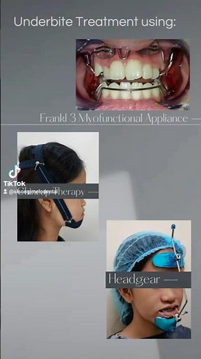 12yo #underbite correction with multiple orthodontic treatment phases #braces