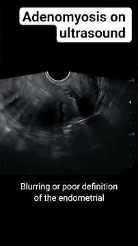 Adenomyosis on ultrasound #radiology #ultrasound
