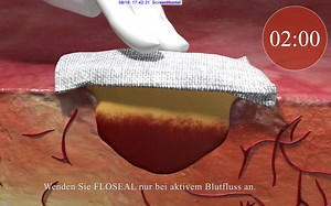 Floseal的止血应用