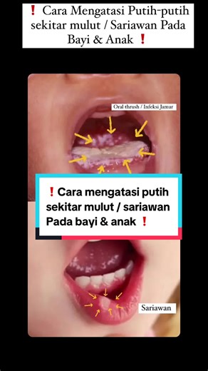 Obat Sariawan untuk Bayi dan Anak: Cara Mengatasi