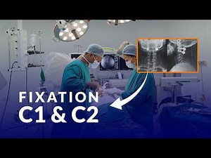 Atlantoaxial Dislocation: A Case Study of Successful C1-C2 Fixation | Dr. Surendra Gupta