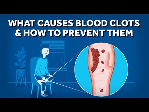 What Causes Blood Clots & How to Prevent Them | DVT & PE Explained