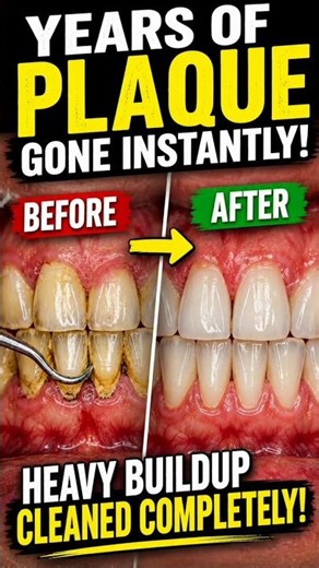 Extreme Plaque Removal Transformation #beforeafter #dentist #dentalartistry #satisfying #asmr