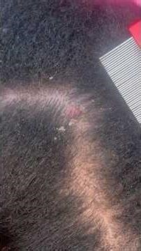 OUCH‼️psoriasis scab‼️ #fypシ゚viral #dandruffscratching #msscratch #flakeslicecomb #asmr #flakes