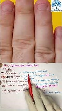 Clubbing of Fingers | Causes, Diagnosis & Mnemonic (Easy)#clubbing #shorts