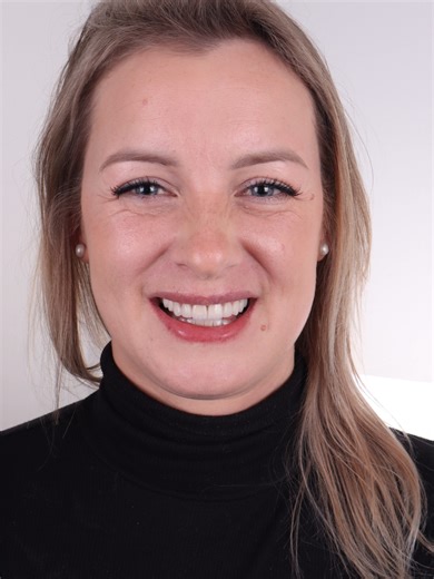 ✨ We completed a Minimal Prep E.max Laminate Veneers treatment for our lovely patient Aggie, who travelled all the way from UK 🇬🇧. E.max laminate veneers are designed to protect your natural teeth by requiring very minimal reduction only on the front surface. This makes them an ideal choice for patients who want a natural, aesthetic, and long-lasting smile. Unlike composite bonding, E.max veneers do not discolor or chip over time and maintain their beauty for many years. Thanks to their durabi