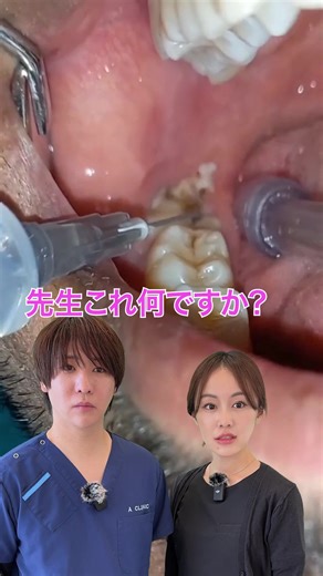 みんな親知らず抜いた❓#dentist #歯磨き #aクリニック