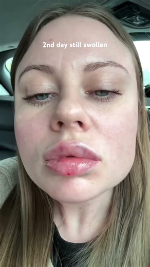 the healing process after lip filler is literally an emotional rollercoaster 😭💋 #lipfiller #lips