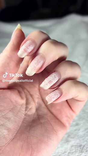 Transform Damaged Nails with IBX Treatment