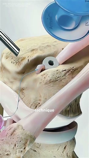 How Distal Biceps Tendon Repair Surgery is Perform? #music #motivation #epic #bicepstendon