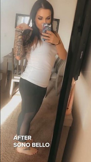 Mommy Makeover Review from Sono Bello | TriSculpt & AbEX Review