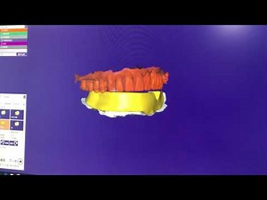 Exocad: Design of complete denture baseplate