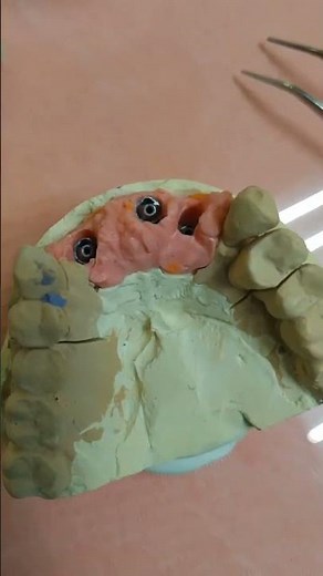 Metal Ceramic bridge 12-22. ICX multi.