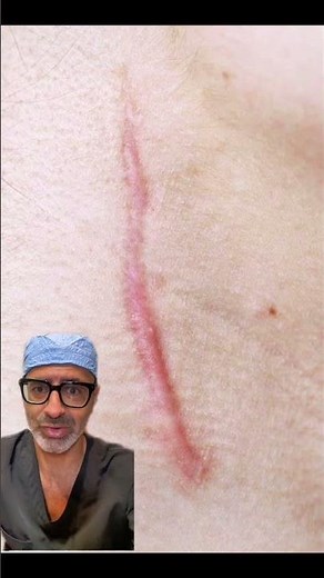 Here’s an example of a hypertrophic scar #hypertrophicscar #incisionscar #plasticsurgery #scarring