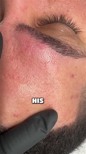 Cold Therapy Treatments for Acne Prone Sensitive Skin