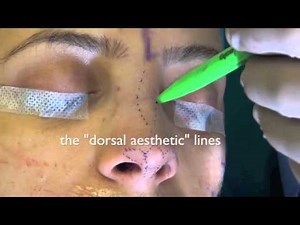 Rhinoplasty: Surface Aesthetics and Surgical Techniques