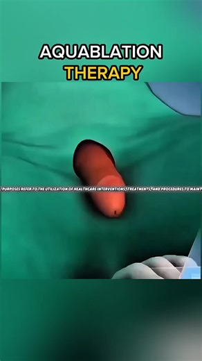 Aquablation Therapy For Enalrged Prostate Treatment! (3D Animation) #enlargedprostate #bph #benignprostatichyperplasia #benignprostatichyperplasiatrea