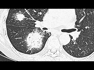 Halo and reverse halo sign CT chest