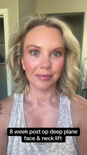 8-Week Post Op Deep Plane Face & Neck Lift Update