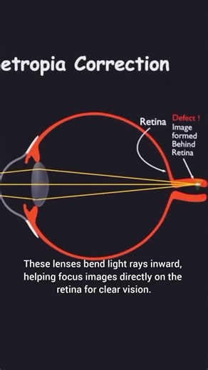 light #eyedefcts. #hypermetropia #defectinvision #funphysics #learningscience