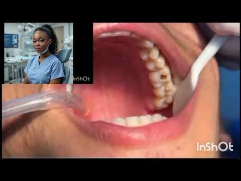 🦷 Dental Filling Explained: Fixing Cavities or holes on the first molar (Step-by-Step)🦷