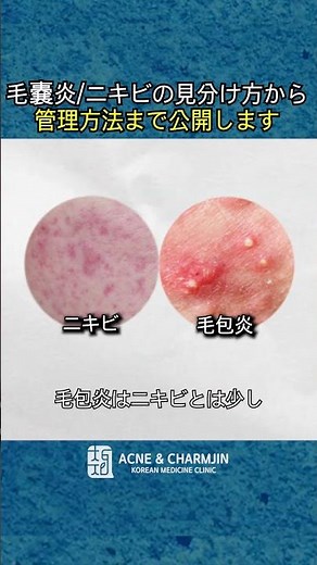 毛嚢炎/ニキビの見分け方から管理方法まで公開します