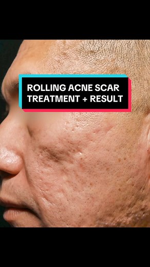 8 MONTH UPDATE FOR ACNE SCAR TREATMENT Please note that I am still actively treating this patient for the remaining volume loss but I wanted to share our progress thus far! We will be performing a fat transfer treatment which will restore the missing volume in the patient’s mid-area of the face. In the meantime let’s breakdown the treatments we have already performed: Taylor Liberator subcision is used to break the fibrous tissue bands that tether the scar to the underlying tissue. For deep and 
