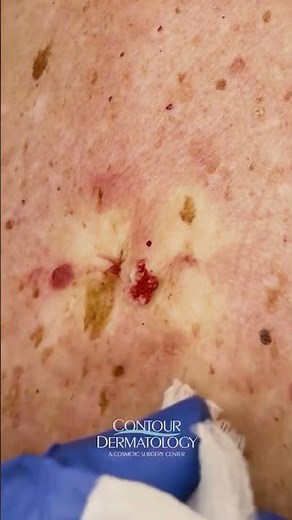 Cyst Regrowth Explained: Why Removal Isn’t Always the End