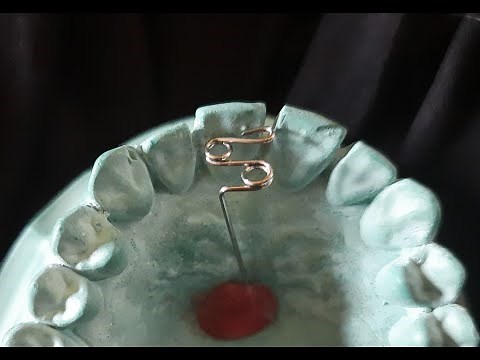Z Spring or Double Cantilever Spring with Indications | Removable Orthodontic Appliance|Orthodontics