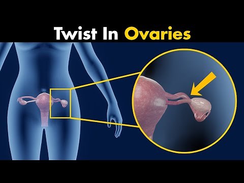 What Causes Ovarian Torsion? | Symptoms, Causes And Treatment (3D Animation)