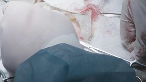 Surgeons perform operation with open incision. Action. Small incision with exposed internal tissues at surgical site. Surgeons cut and sew up internal tissue injuries