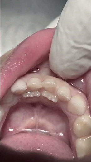 Extraction of deciduous teeth #dentist