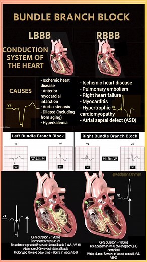 Abdallah Othman | Bundle Branch Block 🚫(LBBB & RBBB), detailing the conduction system, key causes, and ECG patterns. 👍 Like | 📤 Share | 👥 Tag a colleague | ⏳... | Instagram