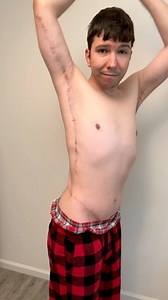 My shark bite scars | Nikocado Avocado