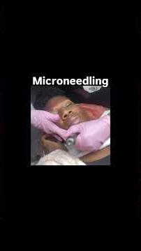 This triggers the skin's wound-healing process, promoting new collagen and elastin formation.