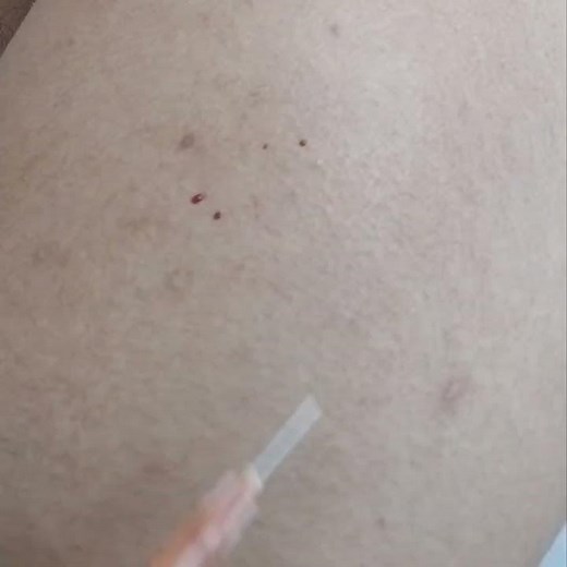 girl getting injection #pavani #injection #prank #inject #intramuscular #asmrmassagespa #painful