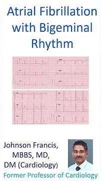 Atrial Fibrillation with Bigeminal Rhythm