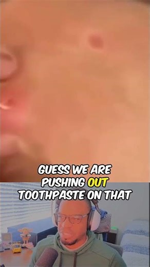 Worm Cyst Pop #pimplepop #cyst #pimple #pimplepopping #reaction #satisfying