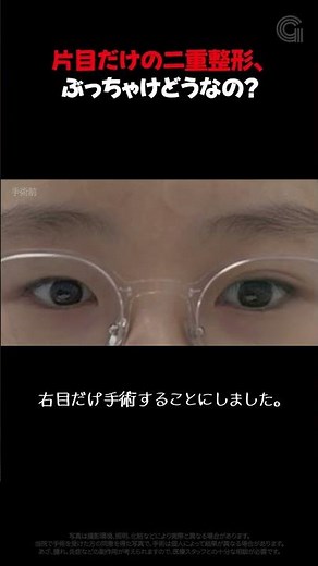 片目だけ二重手術は可能？私が実際にやってみました..