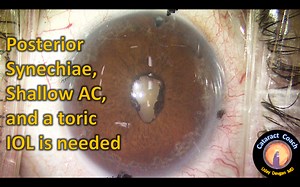 Cataract Surgery with Synechaie Lysis