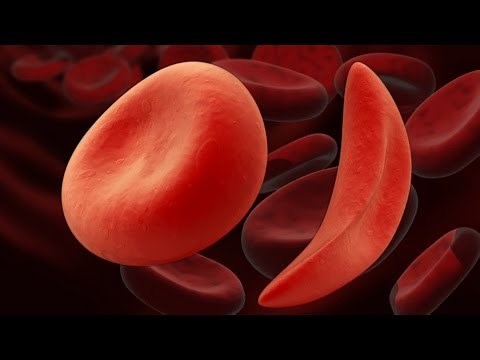 What is sickle cell anemia?