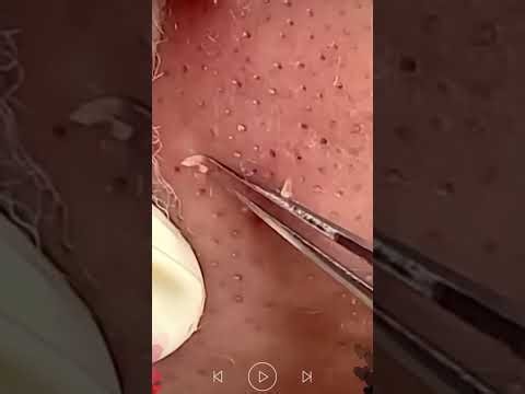 Skincare | Blackheads Removal #765 #tweezers skincare #blackheads blackheads