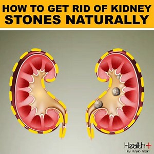 How to Get Rid of Kidney Stones Naturally | Health