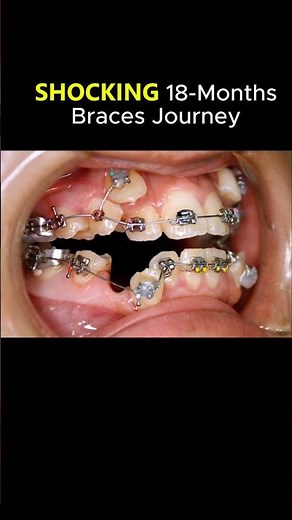 18 Months Braces Transformation: Extreme crooked teeeth fixed #braces #orthodontist #bracesjourney