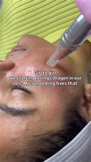 Your mid-20s are when collagen starts slowing down… even if your skin still looks good 👀 Microneedling helps rebuild collagen, smooth texture, tighten pores, and bring back that bouncy, youthful glow we’re all obsessed with!! 💉✨ That’s how we get the glass skin effect, strong skin, healthy skin, skin that actually reflects light 🪞 Glow now, age better later 💖 | NKD. Beauty