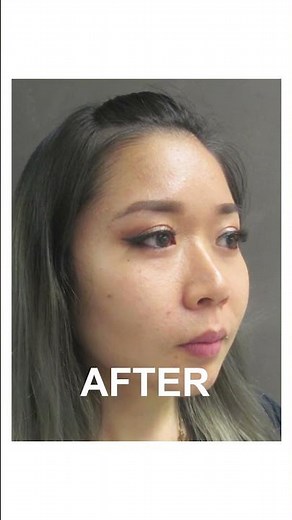 Asian Blepharoplasty (Eyelid Surgery) Before & After Transformation | Dr. Ellis Choy