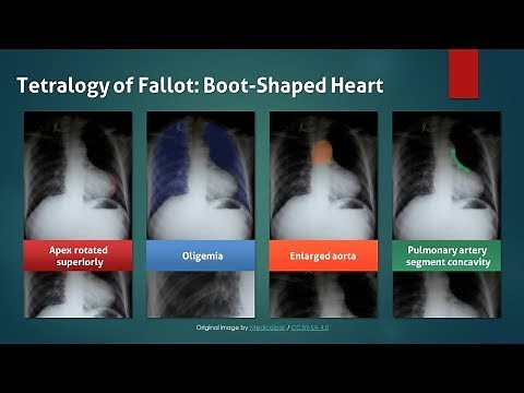 Tetralogy of Fallot: Explanation of Chest X-ray Findings (Boot Shaped Heart)